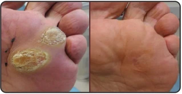 Wart-removal-img