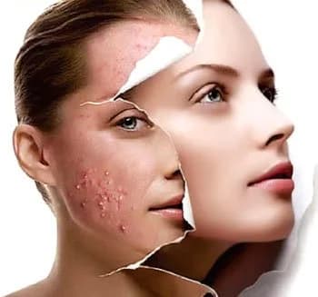 acne-treatment