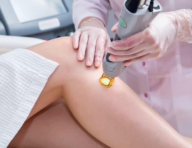 Laser hair removal