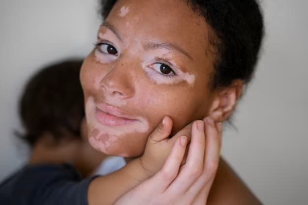 Vitiligo Treatment