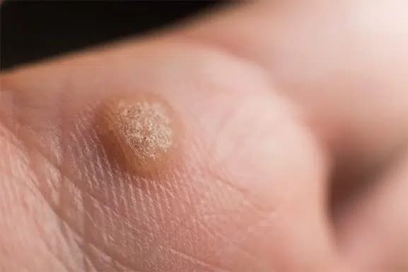 Wart Removal