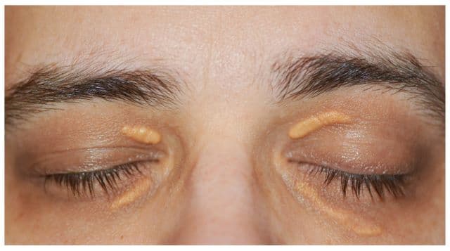 Xanthelasma