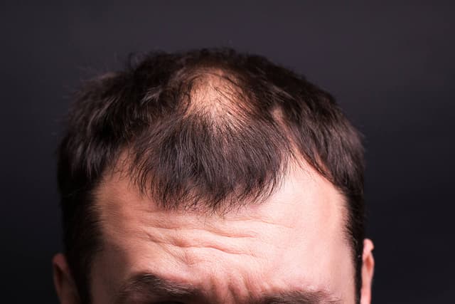 Hair thinning vs Hair fall. What should you consider more severe?